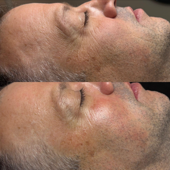Before and after skin texture and rejuvenation results