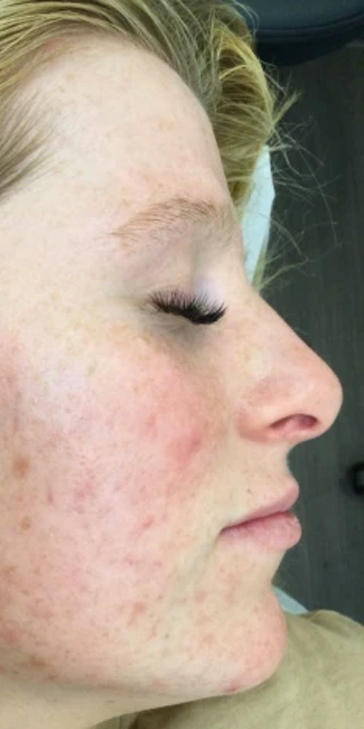 Before and after IPL acne treatment — clearer, calmer skin — after