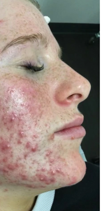 Before and after IPL acne treatment — clearer, calmer skin — before