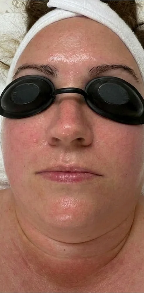 Before and after redness reduction with customized facials and home care — after