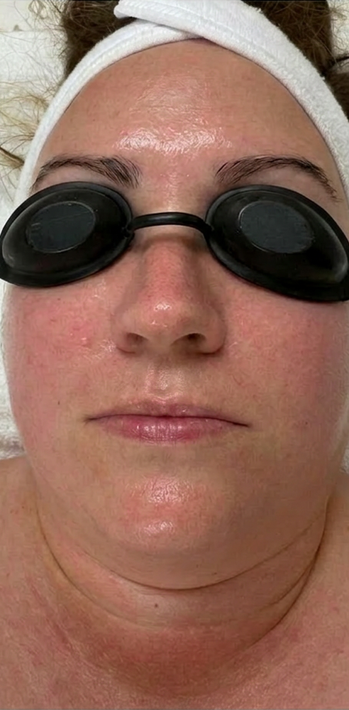 Before and after redness reduction with customized facials and home care — after