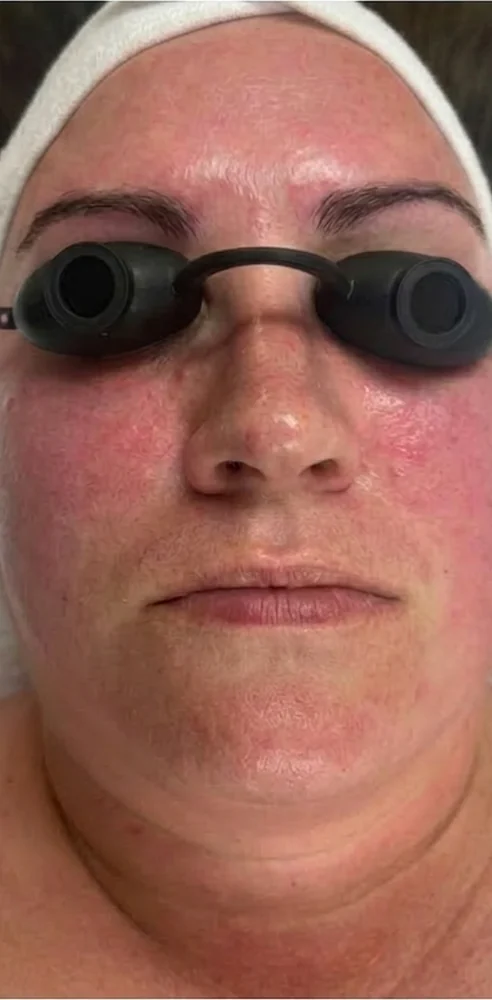 Before and after redness reduction with customized facials and home care — before