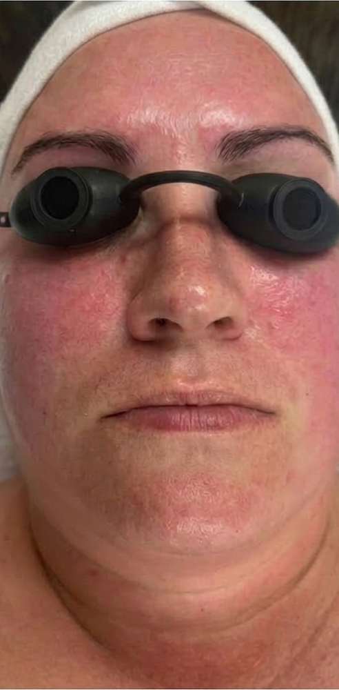 Before and after redness reduction with customized facials and home care — before